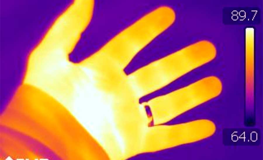 The infrared thermograph of a normal